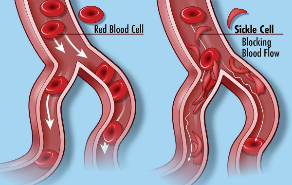 Sickle_cell_re_Main